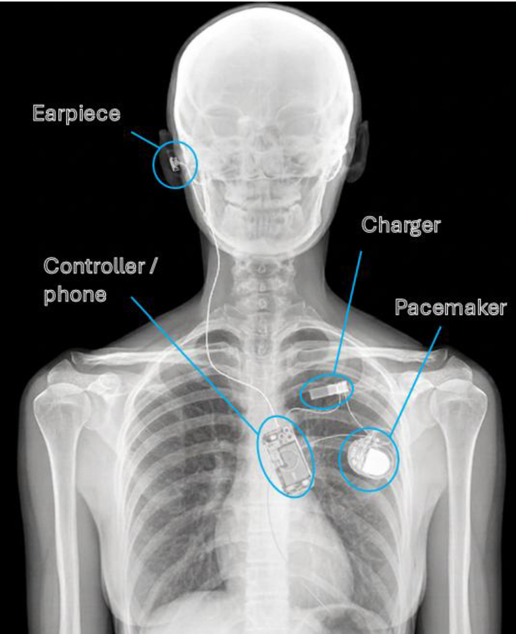 X-ray image of patient #5 demonstrating the Embedix system implantation